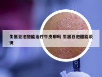 生黑豆泡醋能治疗牛皮癣吗 生黑豆泡醋能淡斑