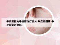 牛皮廨图片牛皮廨治疗图片 牛皮廨图片 牛皮廨能治好吗