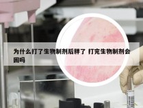 为什么打了生物制剂后胖了 打完生物制剂会困吗