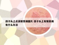 孩子头上点滴银霄病图片 孩子头上有银屑病有什么办法