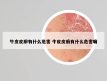 牛皮皮癣有什么危害 牛皮皮癣有什么危害嘛