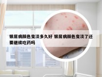 银屑病颜色变淡多久好 银屑病颜色变淡了还要继续吃药吗