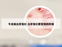 牛皮癣丘疹变红 丘疹变红要警惕四种病