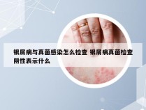 银屑病与真菌感染怎么检查 银屑病真菌检查阴性表示什么