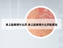 身上起癣用什么药 身上起癣用什么药能根治