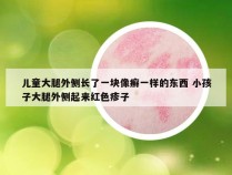 儿童大腿外侧长了一块像癣一样的东西 小孩子大腿外侧起来红色疹子