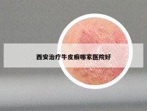 西安治疗牛皮癣哪家医院好