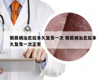 银屑病治愈后多久复发一次 银屑病治愈后多久复发一次正常