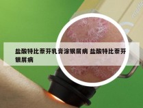 盐酸特比萘芬乳膏涂银屑病 盐酸特比萘芬 银屑病