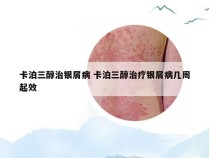 卡泊三醇治银屑病 卡泊三醇治疗银屑病几周起效