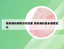 银屑病的病理分析结果 银屑病的基本病理变化