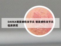 DAREA银屑病性关节炎 银屑病性关节炎临床表现