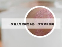 一岁婴儿牛皮癣怎么办 一岁宝宝长皮癣