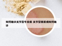 如何确诊关节型牛皮癣 关节型银屑病如何确诊