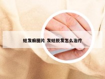 蛀发癣图片 发蛀脱发怎么治疗