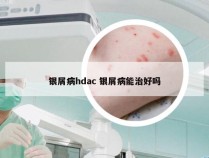 银屑病hdac 银屑病能治好吗