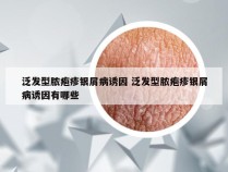 泛发型脓疱疹银屑病诱因 泛发型脓疱疹银屑病诱因有哪些