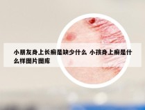 小朋友身上长癣是缺少什么 小孩身上癣是什么样图片图库