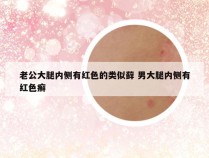 老公大腿内侧有红色的类似藓 男大腿内侧有红色癣