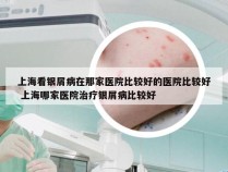 上海看银屑病在那家医院比较好的医院比较好 上海哪家医院治疗银屑病比较好