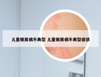 儿童银屑病不典型 儿童银屑病不典型症状