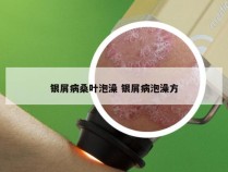 银屑病桑叶泡澡 银屑病泡澡方