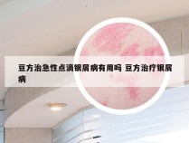 豆方治急性点滴银屑病有用吗 豆方治疗银屑病