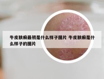 牛皮肤癣最初是什么样子图片 牛皮肤癣是什么样子的图片