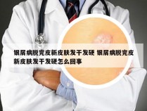 银屑病脱完皮新皮肤发干发硬 银屑病脱完皮新皮肤发干发硬怎么回事