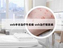 uvb半仓治疗牛皮癣 uvb治疗银屑病