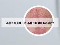 小腿长癣是缺什么 小腿长癣用什么药治疗?