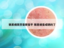 银屑病突然变硬变平 银屑病变成硬的了