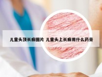 儿童头顶长癣图片 儿童头上长癣用什么药膏