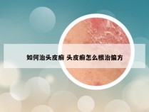 如何治头皮癣 头皮癣怎么根治偏方