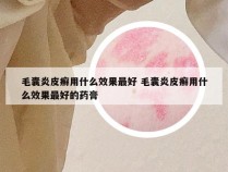 毛囊炎皮癣用什么效果最好 毛囊炎皮癣用什么效果最好的药膏