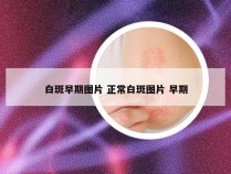 白斑早期图片 正常白斑图片 早期