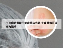 牛皮癣患者能不能吃重庆火锅 牛皮肤癣可以吃火锅吗