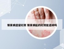 银屑病遗留红斑 银屑病起的红斑能退掉吗