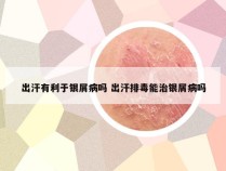 出汗有利于银屑病吗 出汗排毒能治银屑病吗