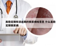 而稳定期和消退期的银屑病啥意思 什么是稳定期银屑病