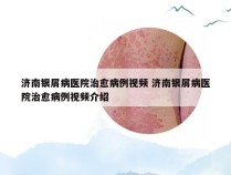 济南银屑病医院治愈病例视频 济南银屑病医院治愈病例视频介绍