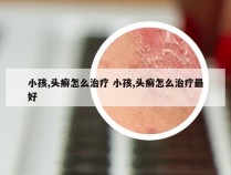 小孩,头癣怎么治疗 小孩,头癣怎么治疗最好