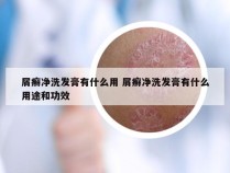 屑癣净洗发膏有什么用 屑癣净洗发膏有什么用途和功效