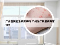 广州医院能治银屑病吗 广州治疗银屑病专家排名