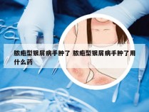 脓疱型银屑病手肿了 脓疱型银屑病手肿了用什么药