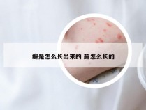 癣是怎么长出来的 藓怎么长的