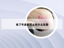 有了牛皮癣禁止吃什么东西