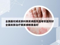 全国最权威皮肤科银屑病医院是哪家医院好 全国皮肤治疗银屑病哪里最好