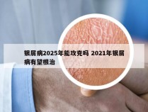 银屑病2025年能攻克吗 2021年银屑病有望根治