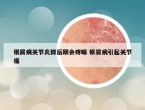 银屑病关节炎脚后跟会疼嘛 银屑病引起关节痛